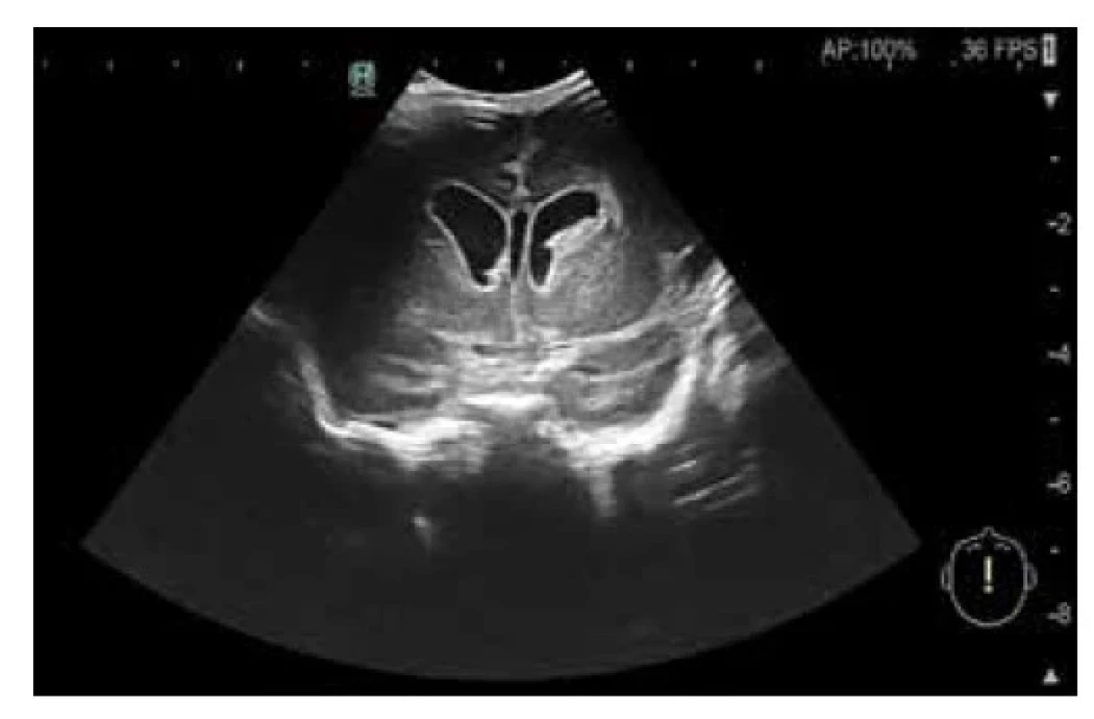 Hyperechogénna kontúra postranných komôr ako
prejav ventrikulitídy v USG obraze (archív Neonatologickej
klinike JLF UK a UNM)