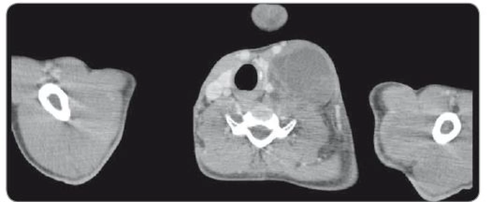 Axial CT scan through left cervical tumor mass pressing thyroid gland and carotid
and internal jugular vein.