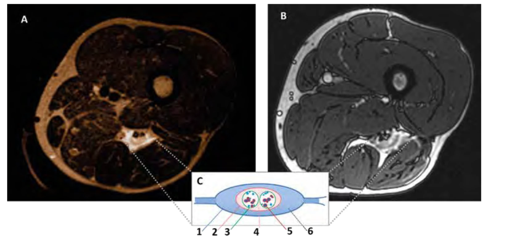 Obaly n. ischiadicus. A. MRI horizontální řez, rozhraní distální třetiny stehna, stav po aplikaci lokálního anestetika 20 ml v subglutální oblasti.
B. MRI horizontální řez, rozhraní proximální třetiny stehna, stav po aplikaci lokálního anestetika 20 ml v subglutální oblasti. C. Schematický náčrtek obalů
ischiadického nervu. 1. myofasciální fascie zadního kompartmentu. 2. společná epineurální pochva ischiadického nervu. 3. perineurium n. tibialis a n.
peroneus communis. 4. epineurální prostor. 5. motorický fascikl. 6. teleskopické vazivo