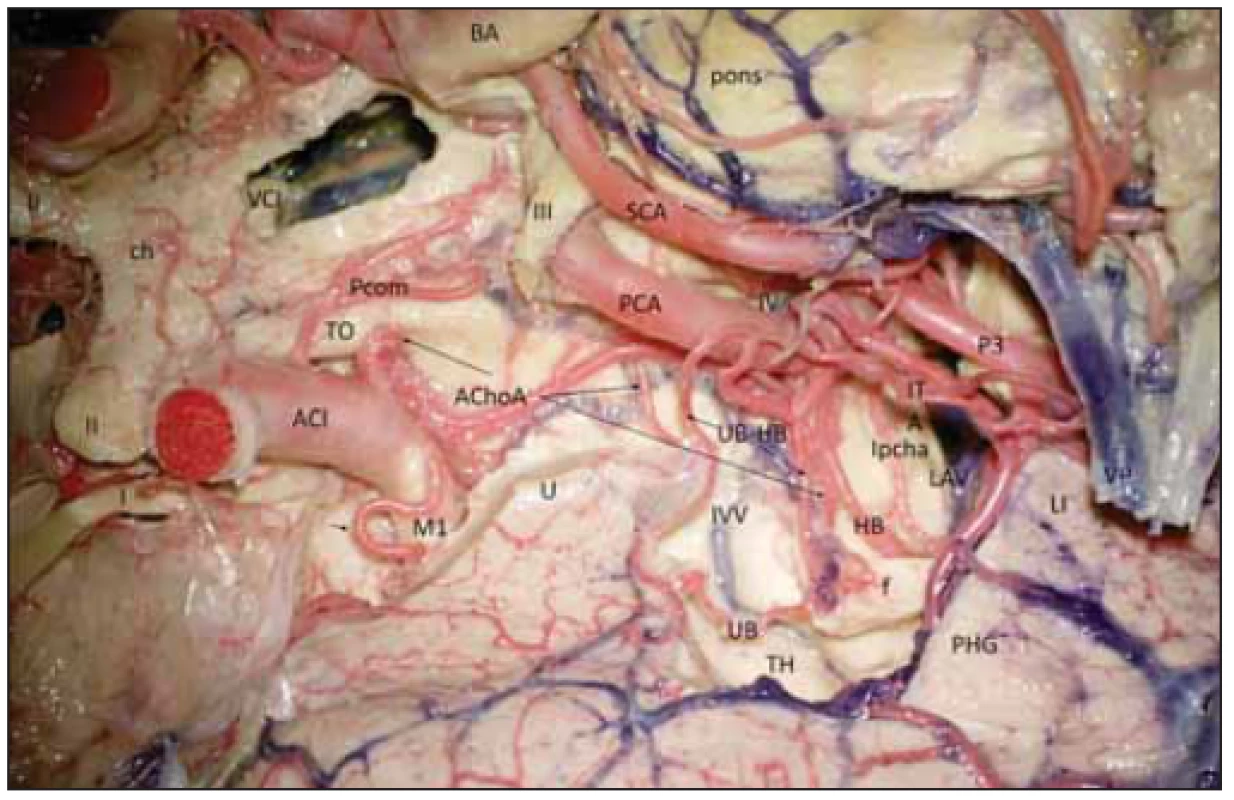 Cévní zásobení hipokampálního komplexu vpravo (preparát s cévami barvenými
silikonem). <br>
Fig. 3 Vascular supply of the hippocampal complex (dyed silicon perfusion) on the right
side.