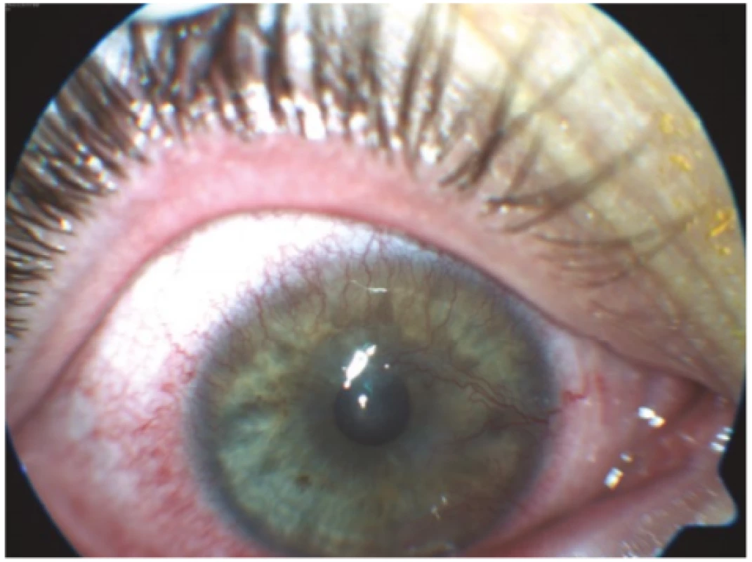  Right eye of patient from case report 1, visible
mixed corneal vascularisation