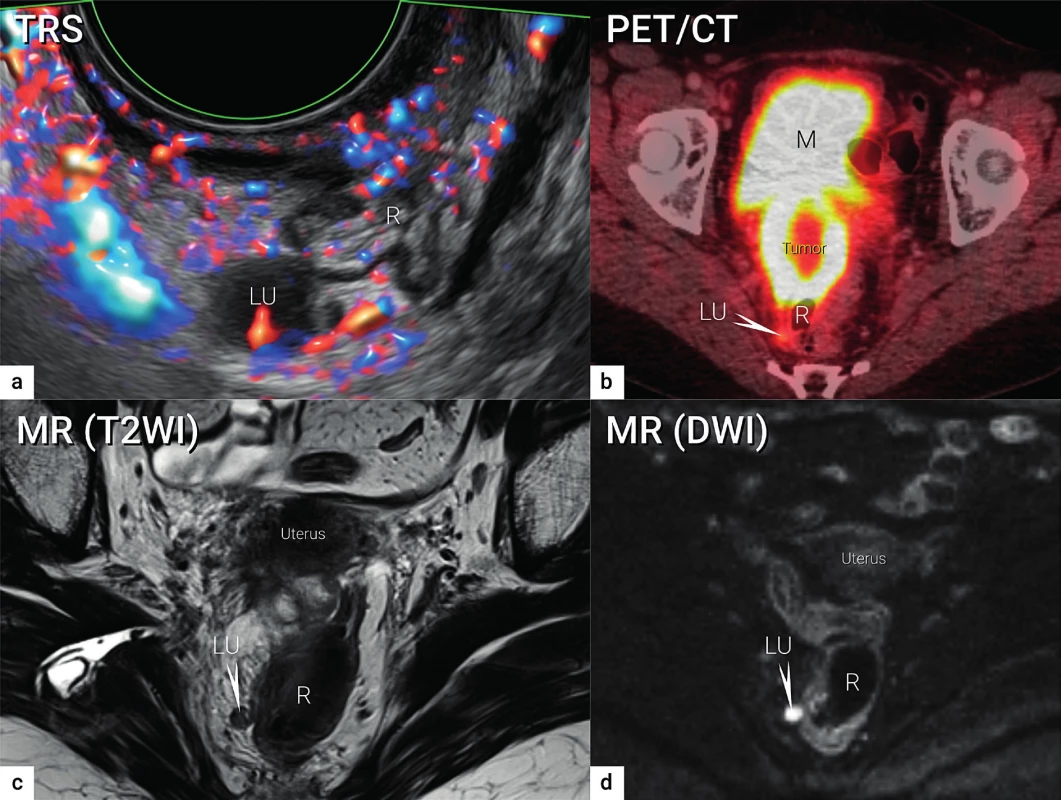 Zobrazení lymfatických uzlin<br>
Viscerální metastatická lymfatická uzlina o velikosti 10 mm uložená v pravém sakrouterinním vazu podle transrektálního ultrazvuku (a),
PET/CT (b), MR (T2WI)(c) a MR (DWI)(d).
TRS – transrektální ultrazvuk; PET/CT – pozitronová emisní tomografie fúzovaná s CT; MR (T2WI) – magnetická rezonance s T2 váženými
obrazy (T2WI, T2 weighted images); MR (DWI) – magnetická rezonance se zobrazením difuze (DWI – diffusion weighted images); LU –
lymfatická uzlina (označena šipkou v b, c, d); R – rektum; M – močový měchýř