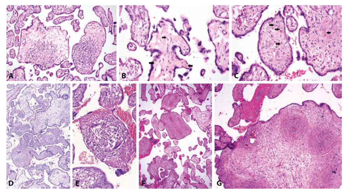 A: Chronická lymfoplasmocytární vilitida při infekci CMV (HE, 200x). B: CMV placentitida. Drobná depozita hemosiderinu (šipky) ve stromatu choriového
klku (HE, 400x). C: CMV placentitida. Virové inkluze (šipky) (HE, 400x). D: Granulomatózní vilitida při infekci Toxoplasma gondii (HE, 150x). E: Toxoplasmová
infekce placenty. Granulomatózní vilitida s přítomností obrovských mnohojaderných buněk (HE, 400x). F: Syfilis. Lymfoplasmocytární vilitida a koncentrická
perivaskulární fibroproliferace (HE, 100x). G: Syfilis. Koncentrická perivaskulární fibroproliferace („onion skin villi“) (HE, 400 x).