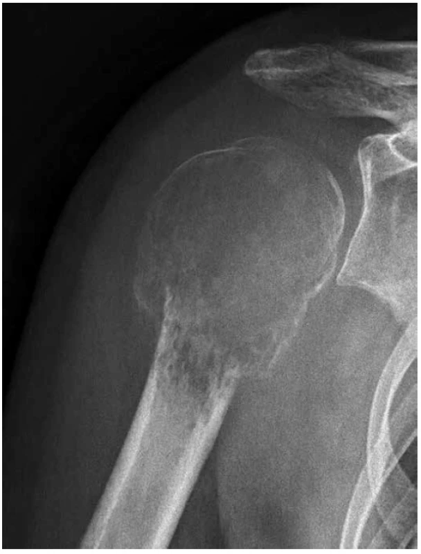 Rozsáhlý, agresívně rostoucí osteolytický tumor, deformující metaepifýzu
hlavice pažní kosti s uzurací kortikalis, avšak bez progrese do měkkých
tkání (RTG).
