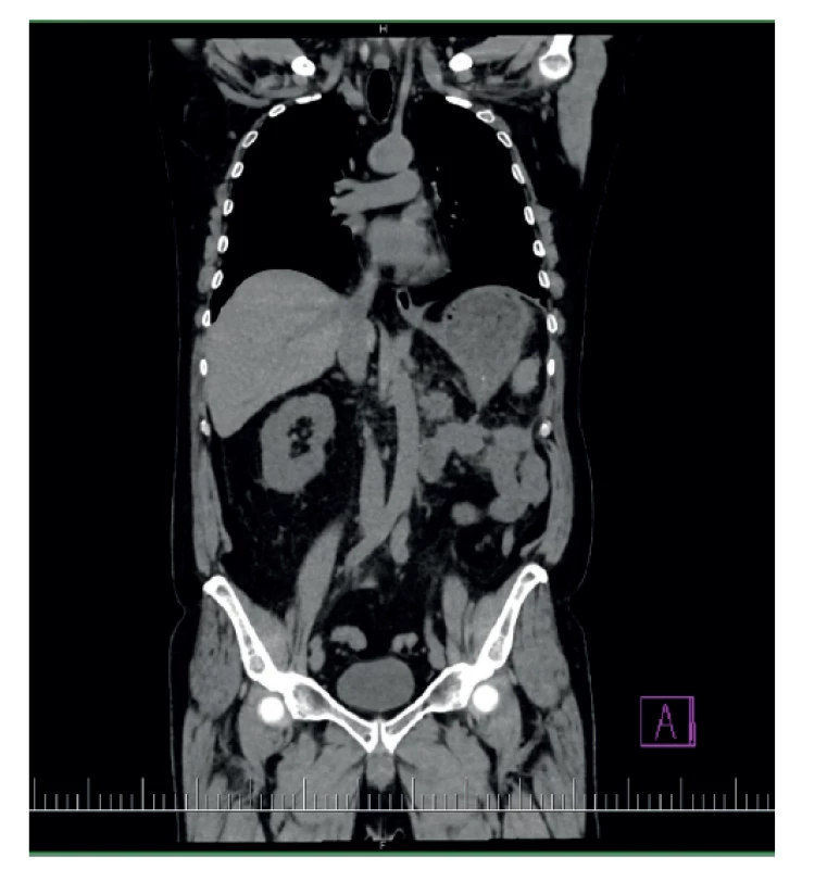 Pooperačný stav po nefrektómii<br>
Fig. 10: Postoperative condition after nephrectomy