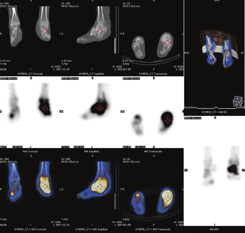Fúze funkčního a strukturního obrazu (SPET/CT) u stejného pacienta. Tento způsob zobrazení
umožňuje přesnou anatomickou lokalizaci metabolických změn
