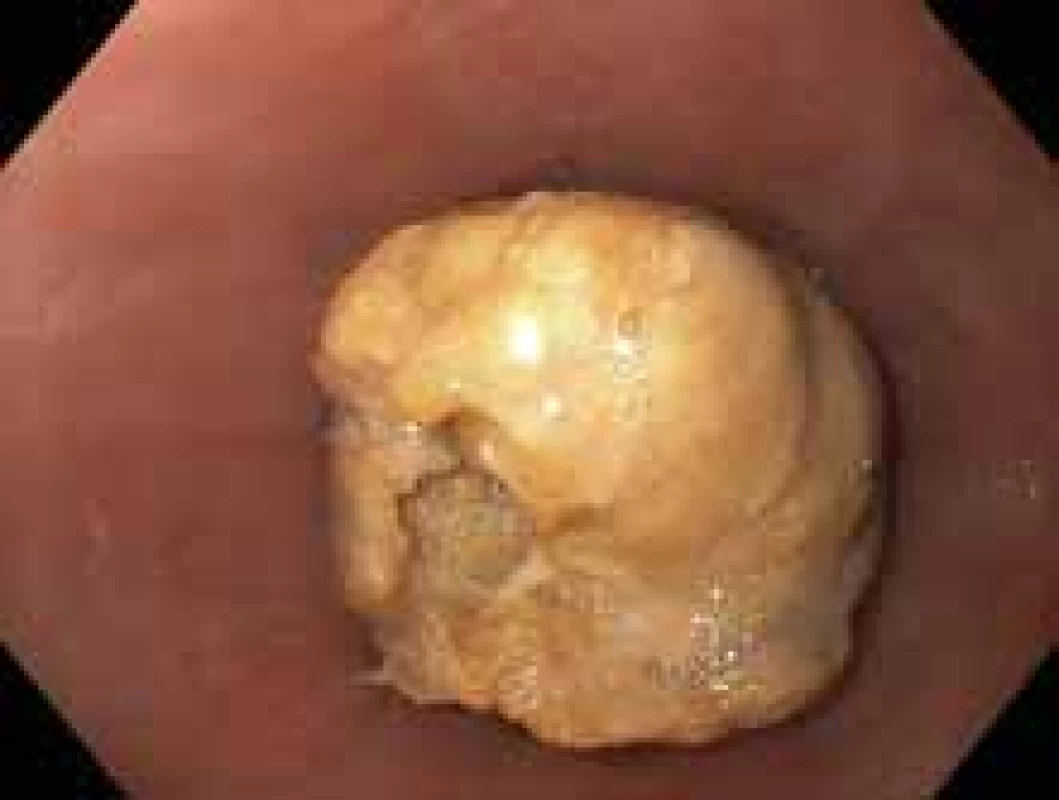 Impaktované sousto.<br>
Fig. 3. Impacted food bolus.