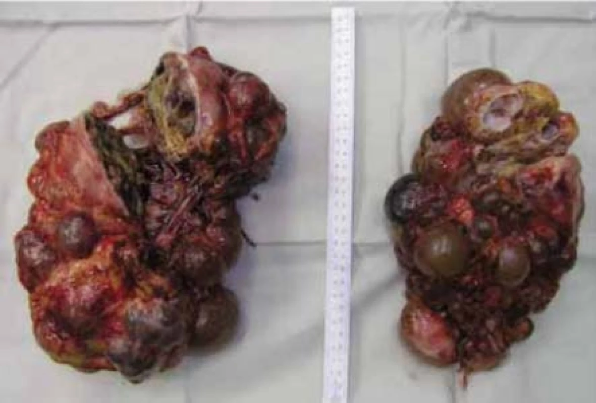 Žena, 38 let, VHL syndrom. Preparát po oboustranné transperitoneální nefrektomii, histologicky
vícečetné světlobuněčné renální karcinomy<br>
Fig. 6. Thirty-eight year old female with a VHL syndrome. Kidneys after transperitoneal bilateral nephrectomy,
histologically multiple clear cell renal cell carcinomas