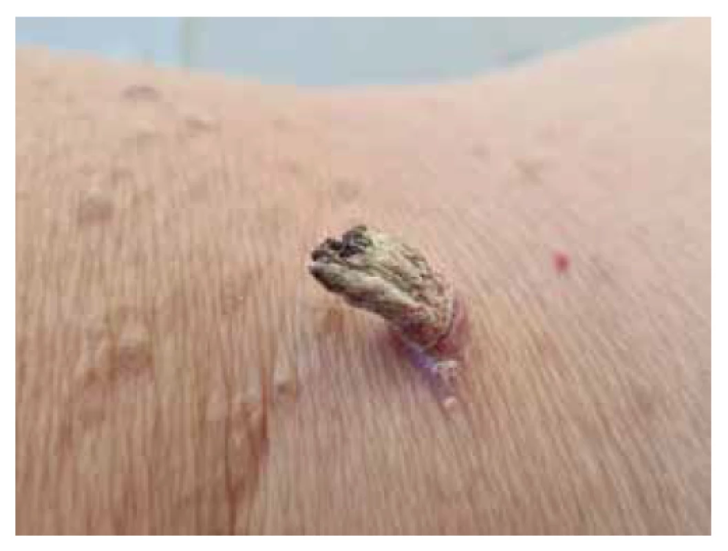 Cornu cutaneum