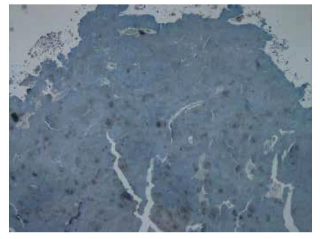 Imunohistochemické vyšetření v reakci s protilátkou proti amyloidu
A bez známek pozitivity. Původní zvětšení snímku 40x