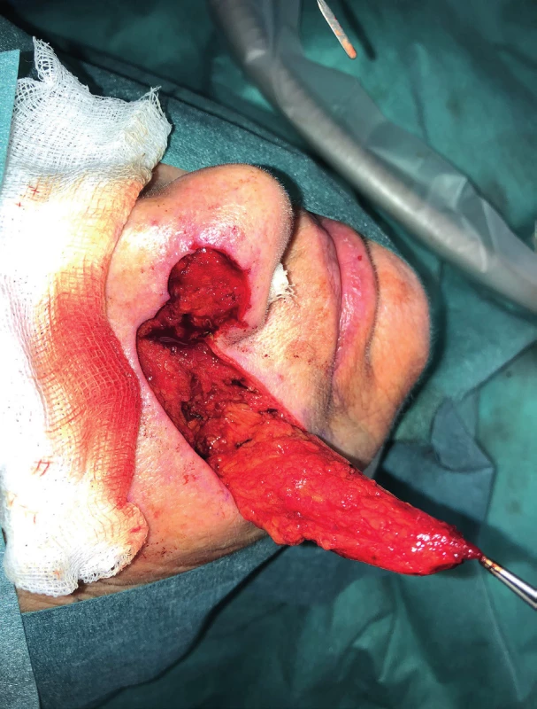 Elevation of the nasolabial flap (author’s archive)