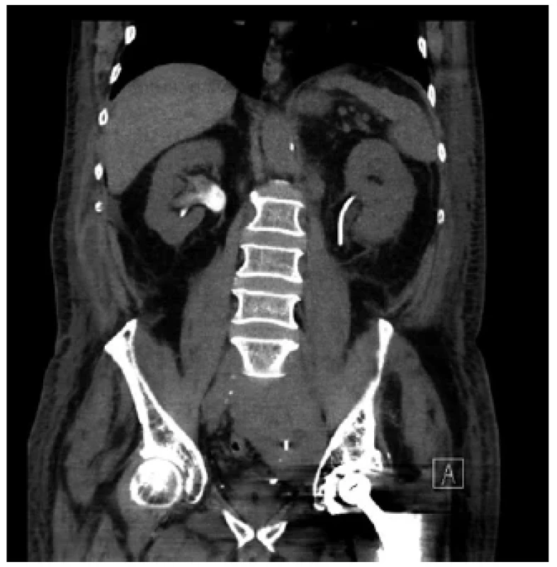 CT – vlevo zavedený ureterální stent ve správné
poloze <br> 
Fig. 1. CT – ureteral stent placed in the correct position
on the left
