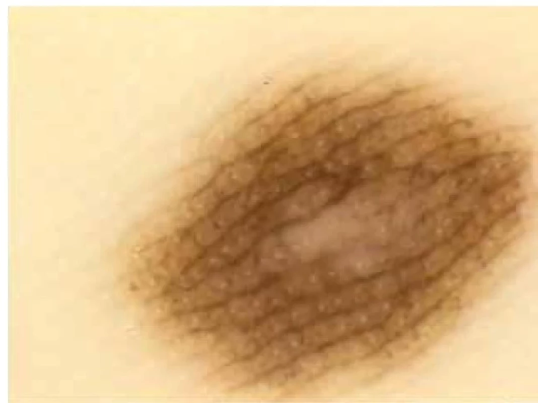 Melanocytový névus<br>
„Parallel furrow pattern” – paralelně probíhající tenká lineární
pigmentace v sulci superficiales, viditelná akrosyringia.