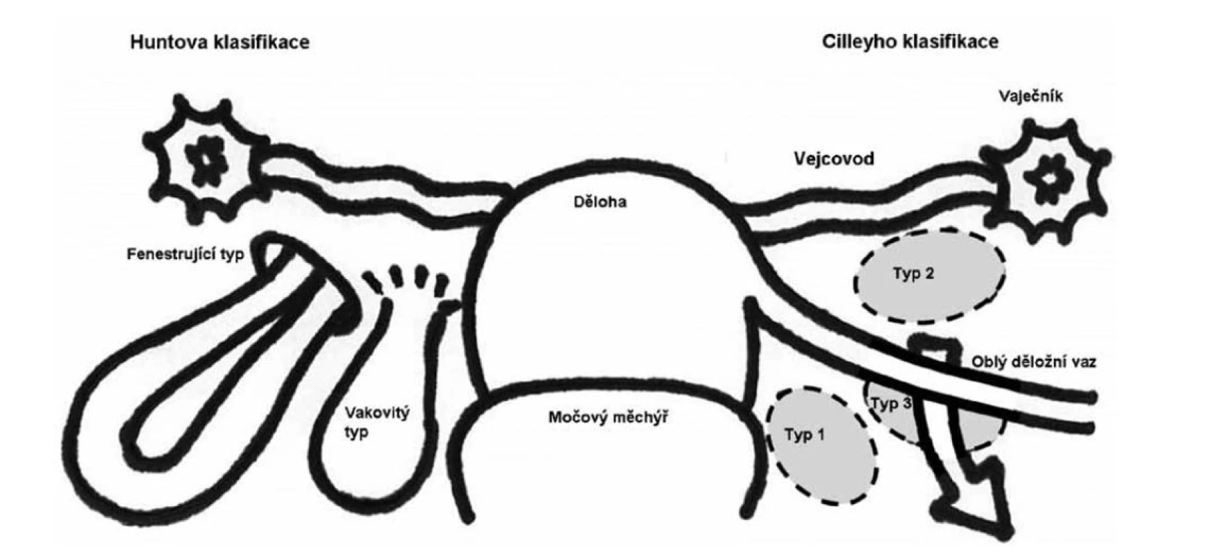 Klasifikace defektů děložních vazů [3]<br>
Fig. 1: Classification of uterine ligament defects [3]