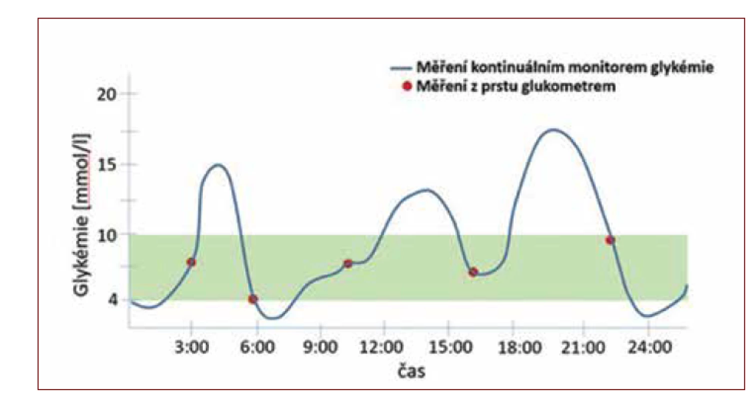 Glykemický profil zobrazený kontinuálním monitorem glykemie