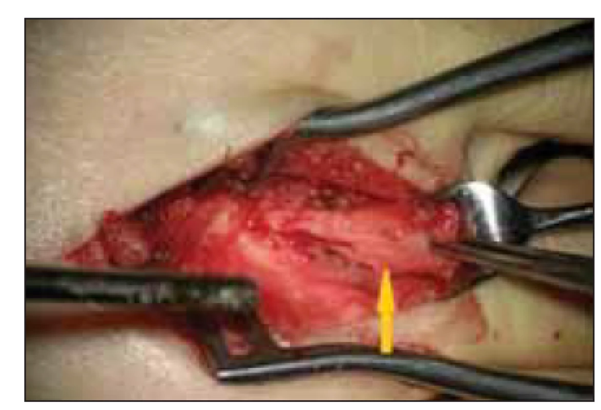 Resekce neuromu z dorzálního přístupu.
Neurom (šipka).<br>
Fig. 4. Neurectomy through a dorsal
approach. Neuroma (arrow).
