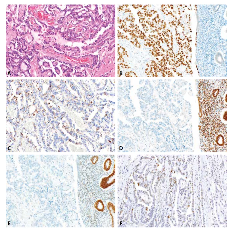 Světlobuněčný karcinom endometria. Převáženě papilárně a glandulárně uspořádaný karcinom fokálně s hyalinizacemi stromatu papil
(4A, HE, 200x). Nádorové struktury vakazují silně intenzivní jadernou pozitivitu HNF1B (4B, 200x), disperzní granulární cytoplazmatickou pozitivitu
napsinu A (4C, 200x), negativitu estrogenových a progesteronových receptorů (4D, 4E, 200x) a „wild-type“ expresi p53 (4F, 200x).