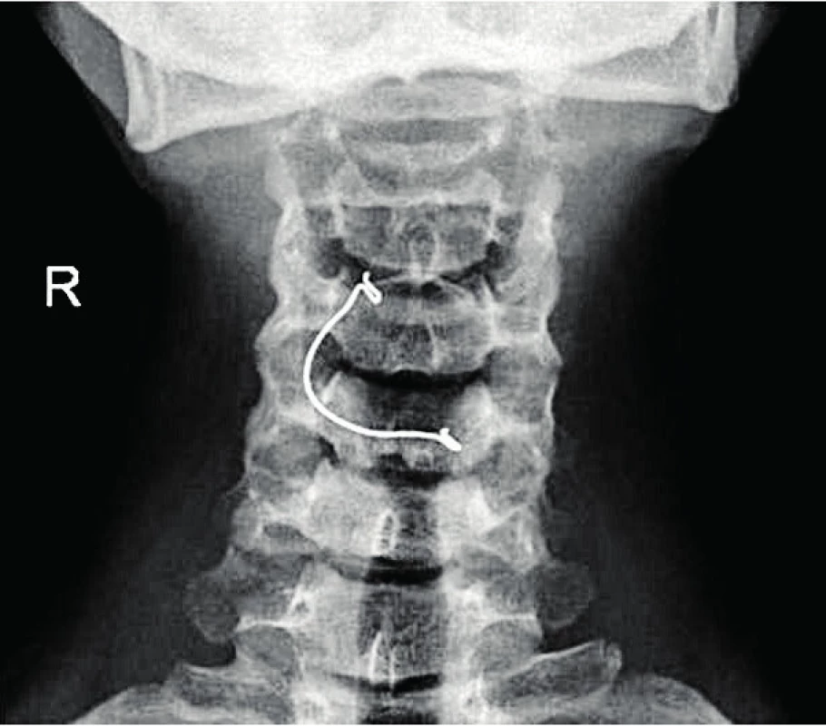  Část rovnátek ve vchodu do jícnu, předozadní snímek.<br><b> Fig. 9.  </b>Part of dental braces in the entrance to the esophagus, anterior-posterior projection.
