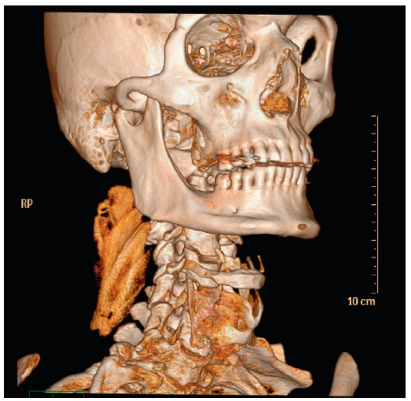 Rekonstrukce tekutinové náplně prostoru mezi
m. levator scapulae a skupinou erektorů. Na 3D rekonstrukci
otisku svalů je patrná stavba jednotlivých svalových snopců.