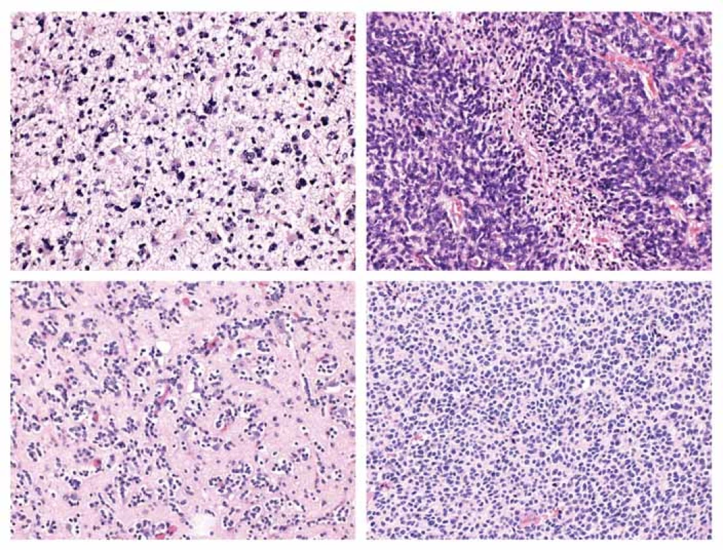 Typická morfologie infiltrujících gliomů.<br>
A) Difúzní astrocytom, středně celulární nádorová proliferace tvořena atypickými fibrilárními astrocyty.<br>
B) Glioblastom, hypercelulární tumor s palisádující nekrózou.<br>
C) Oligodendrogliom, středně celulární proliferace oválných buněk s perinukleárním projasněním v síti bohatě větvených kapilár.<br>
D) Anaplastický oligodendrogliom, hypercelulární proliferace s briskní mitotickou aktivitou.<br>
A–D) Hematoxylin-eozin, původní zvětšení 200×