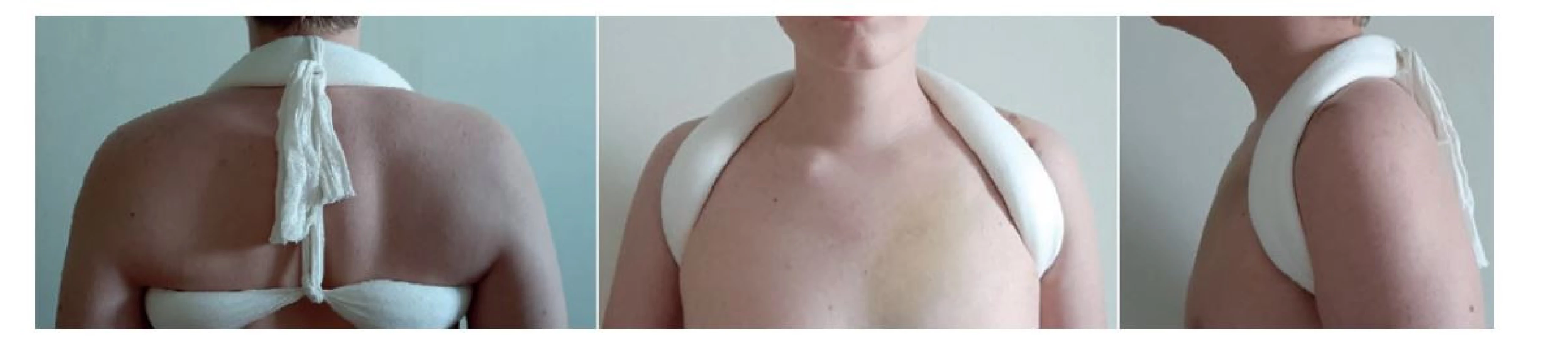 Madzenova fixace<br>
Fig. 1. Madzen fixation