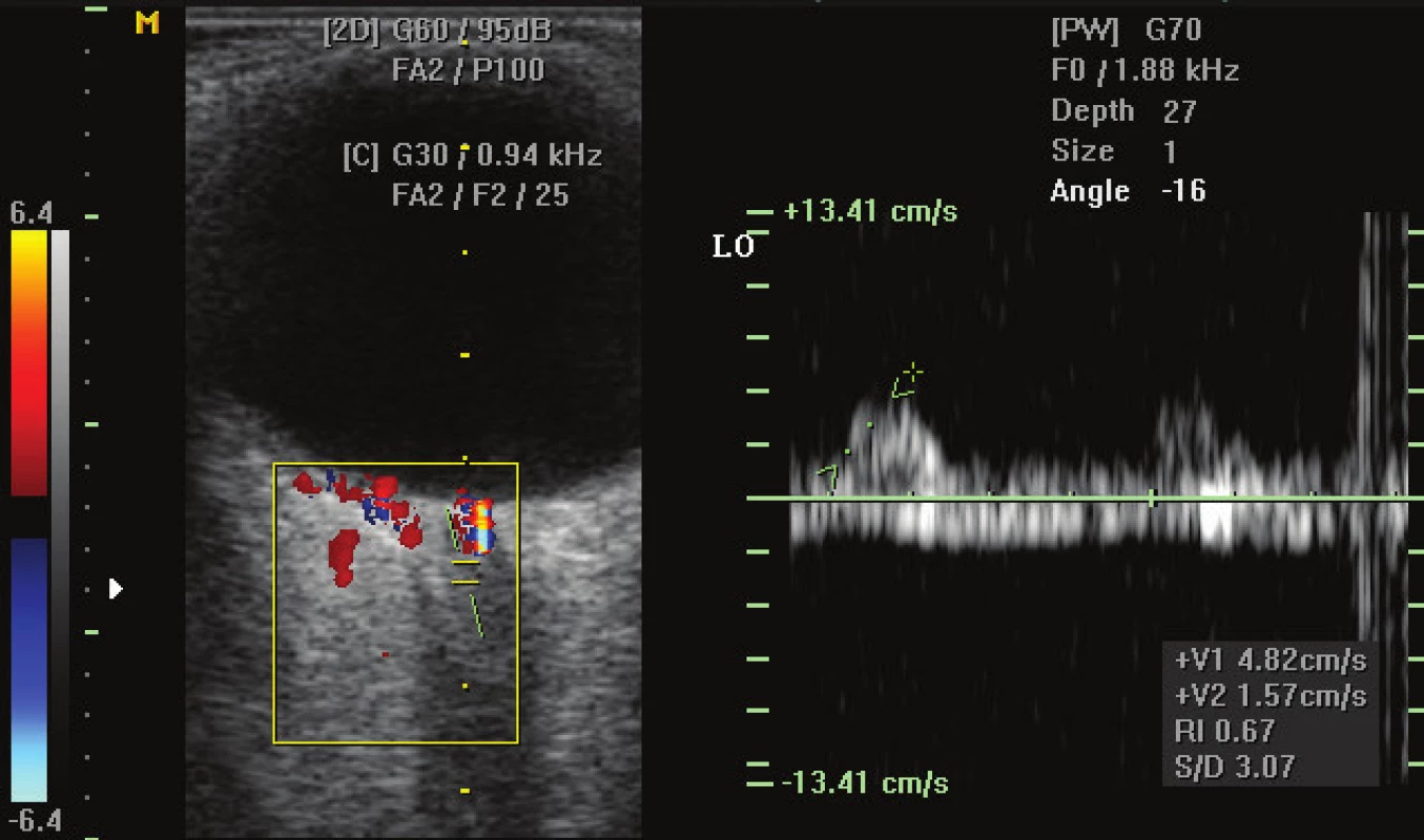 Colour Doppler ultrasonography – pronouncedly low flow parameters in
central retinal artery