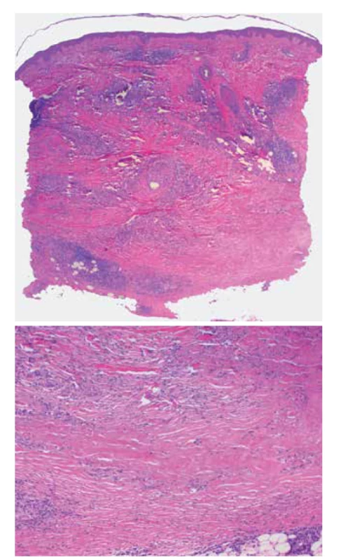 Necrobiosis lipoidica<br>
a) horizontálně probíhající nekrobiotické okrsky vaziva obklopené
perivaskulárním a intersticiálním zánětlivým infiltrátem
(HE 25x)<br>
b) nekrobiotický okrsek zrnitě se rozpadajícího vaziva
(HE 100x)