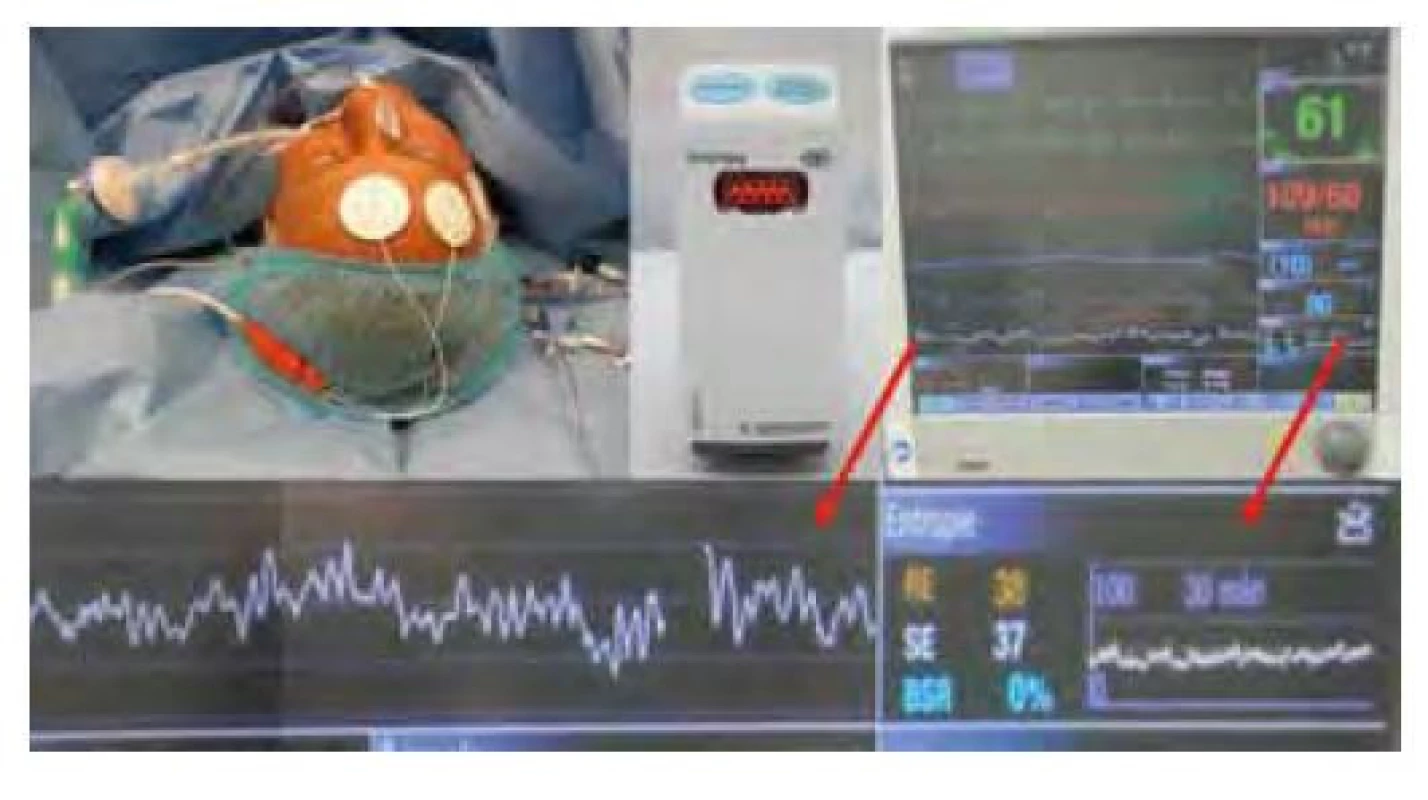 Pacient s elektrodami GE Entropy, modul, záznam entropie na
monitoru a detail záznamu, na němž je jeden svod EEG, hodnoty RE (Resting
Entropy) 38, SE (State Entropy) 37, BSR (Burst Suppression Ratio) 0 % a trend
hodnot RE a SE v posledních 30 minutách lehce pod doporučeným rozmezím
40–60