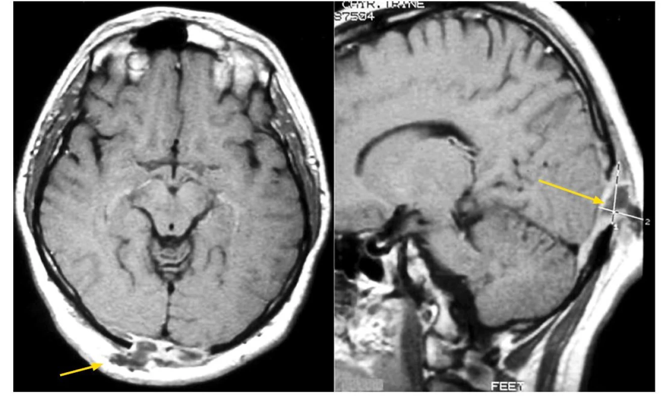 LCH postihuje velmi často lebeční kosti, ale může postihnout kteroukoliv kost v těle. Kostní ložiska LCH mají osteolytický charakter, ale tumorózní
hmoty mohou expandovat do okolí kosti a způsobovat hmatné zduření, pokud expandují zevně. Na MR zobrazení je zřetelný osteolytický proces okcipitálně,
který expandoval jak vně kosti, takže pacient udával v tom místě hmatné zduření, tak také expandoval do nitra kalvy a komprimoval šedou koru
mozkovou v oblasti zrakového centra, což se projevilo poruchou zraku. Po léčbě kladribinem se vše upravilo a pacient je více než 10 let v remisi. K podobné
osteolýze s expanzí zevně i dovnitř může dojít v kterékoliv lebeční kosti