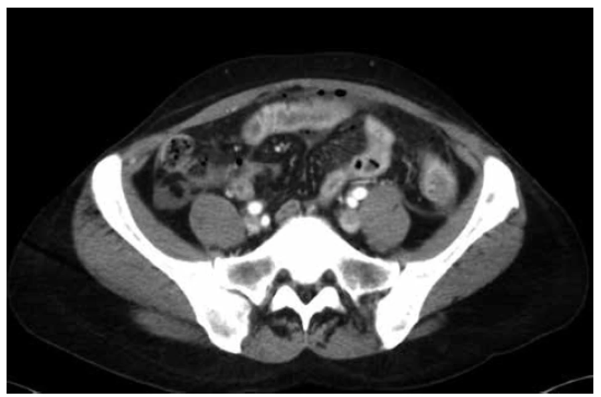 CT obraz poranění jejuna, bublinky plynu pod
břišní stěnou, zvýšená denzita mezenteria, proužky volné
tekutiny v dutině břišní<br>
Fig. 1. CT scan of a jejunal trauma, traces of gass under
the abdominal wall, high density of mesenterial fat, free
peritoneal fluid