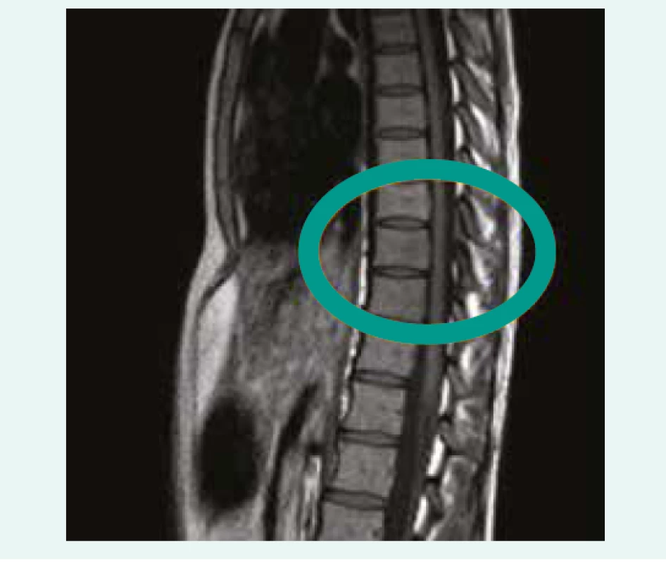 Control MRI after 3 months showing
regression of SEA, sagital scan. Department
of Radiology, and Nuclear Medicine