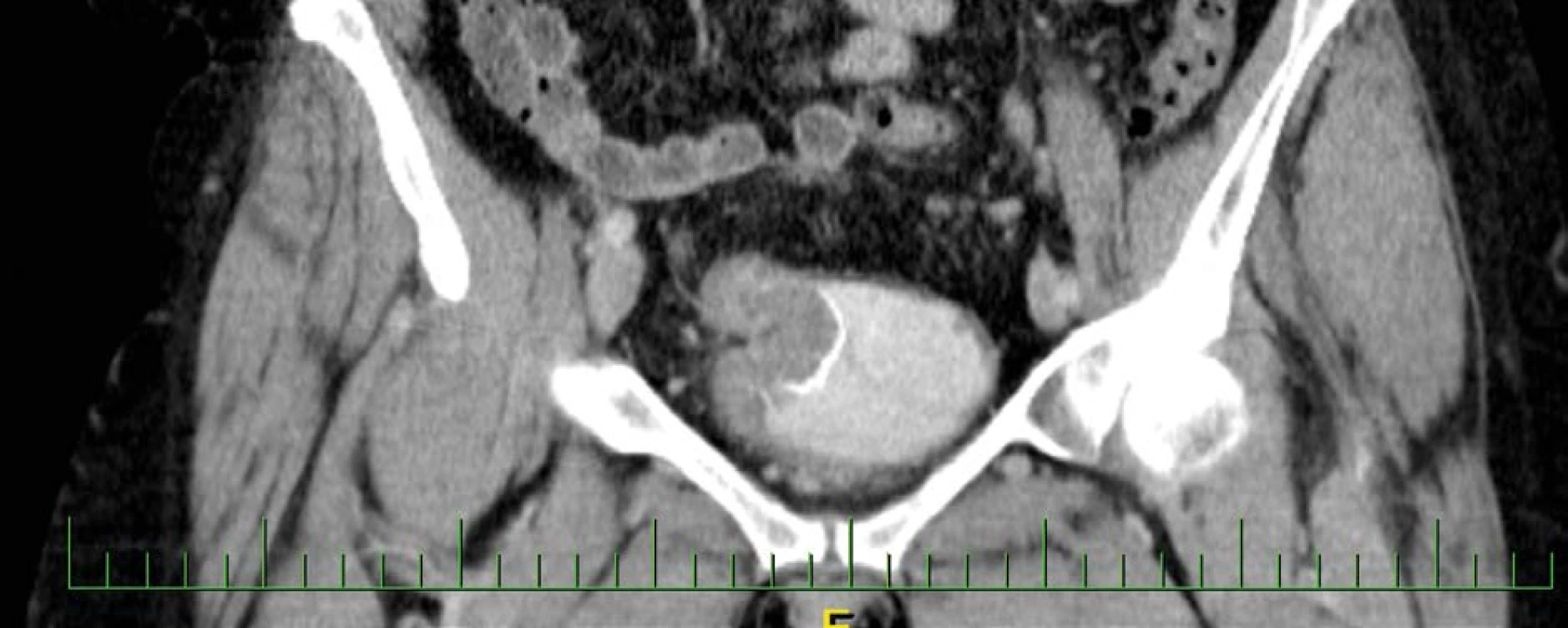 CT vyšetření zachycující intraluminální expanzi v augmentovaném močovém měchýři<br>
Fig. 2. CT examination capturing intraluminal expansion in the augmented bladder
