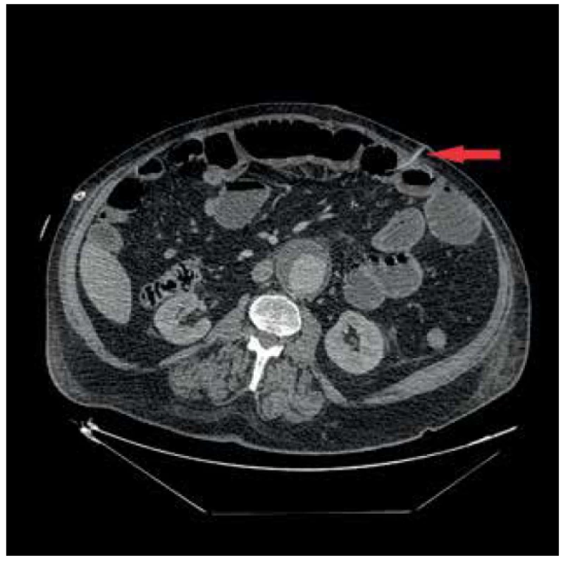 Jejunostomický katetr zavedený proximálně od píštěle<br>
Fig. 2. Jejunostomal catheter inserted proximally to the fistula