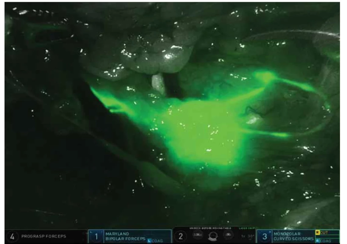 Sentinelová lymfatická uzlina v supraobturátorové oblasti – Da Vinci Firefly Mode.<br>
Fig. 1. Sentinel lymph node in the supraobturator region – Da Vinci Firefly Mode.