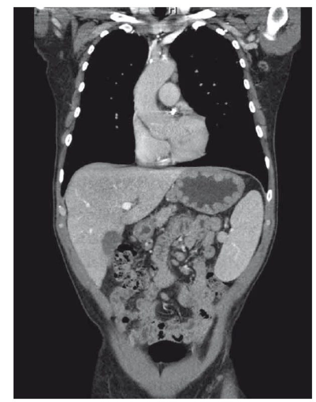 CT obraz zesílené stěny žaludku, hepatosplenomegálie,
abdominální lymfadenopatie, sagitální řez.
Fig. 1. CT scan of thick gastric wall, hepatosplenomegaly,
abdominal lymphadenopathy, saggital.