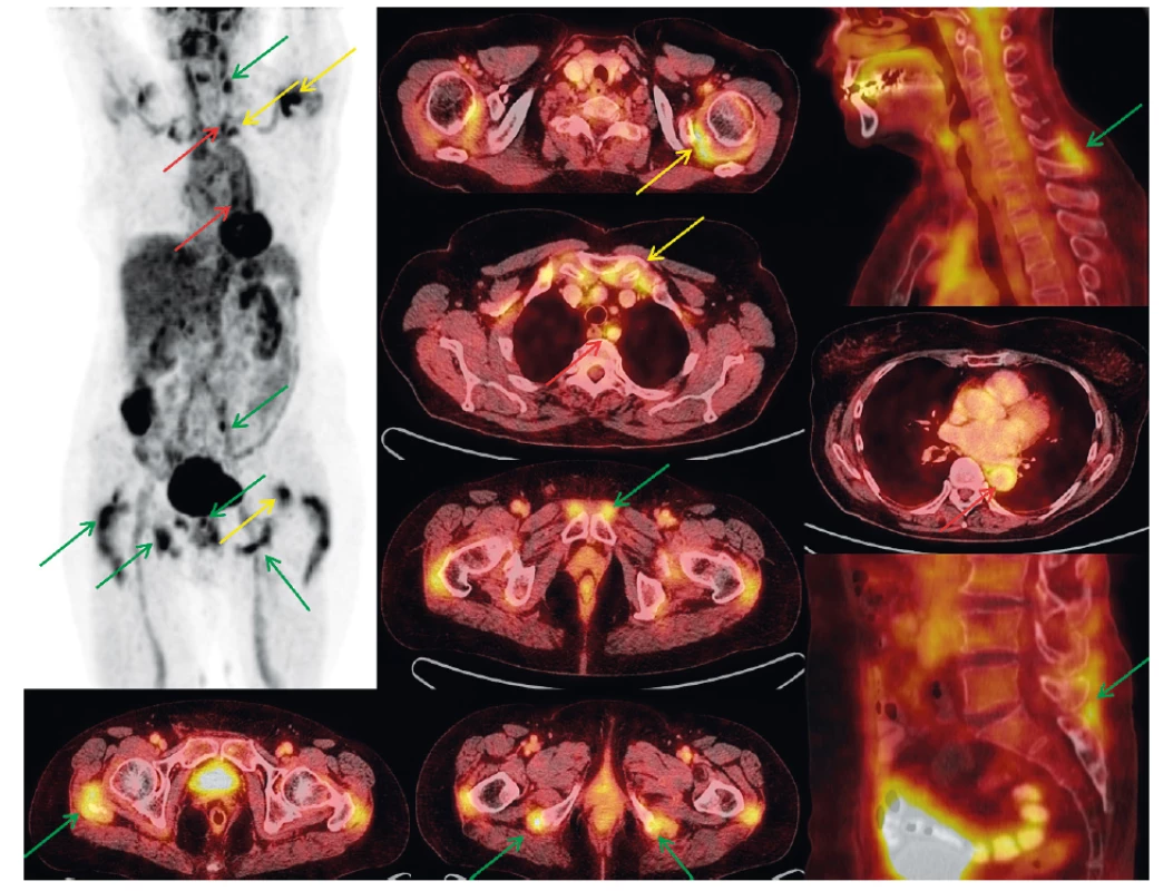 FDG PET vyšetření trupu u 77leté pacientky s klinickým obrazem PMR a nálezem na PET/CT. MIP PET (černobílý) obraz pootočen,
aby nedošlo k sumaci nálezů při střední čáře. Dále detaily hybridních PET/CT obrazů na jednotlivá místa postižení (axiální a sagitální
roviny). Artikulární/periartikulární zobrazení (ramena, sternoklavikulární skloubení) – žluté šipky. Extraartikulární nálezy (cervikální a lumbální
interspinózní prostory, okolí sedacích hrbolů, velkých trochanterů, symfýzy) – zelené šipky. Vaskulární zobrazení (extrakraniální tepny, aorta a její
odstupy) – červené šipky.