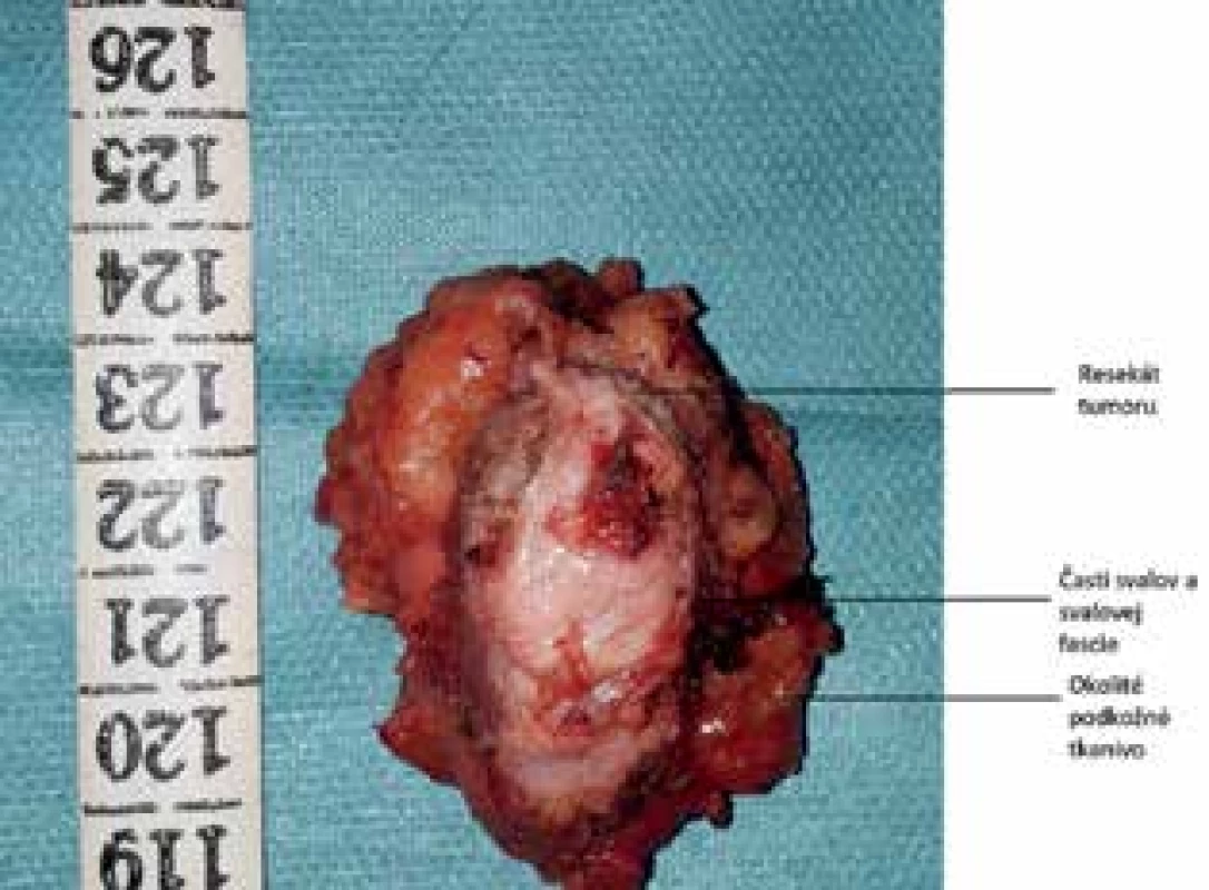 Resekát tumoru brušnej steny<br>
Fig. 4: Resected tumor of the abdominal wall