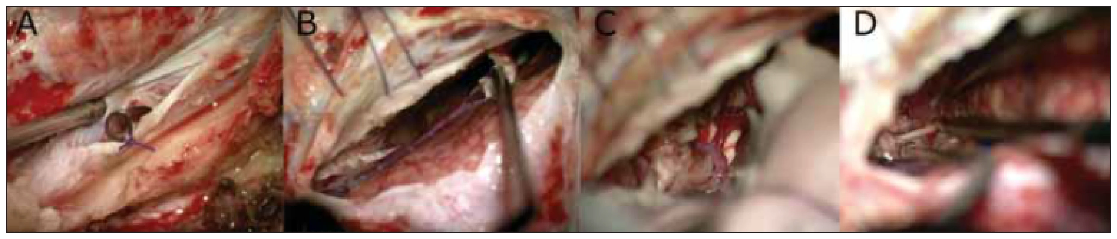 Technické detaily resekce recidivy glioblastoma multiforme transtentoriálně vlevo.   <br>
Fig. 6 Technical details of a glioblastoma multiforme recurrence resection by a left transtentorial approach.