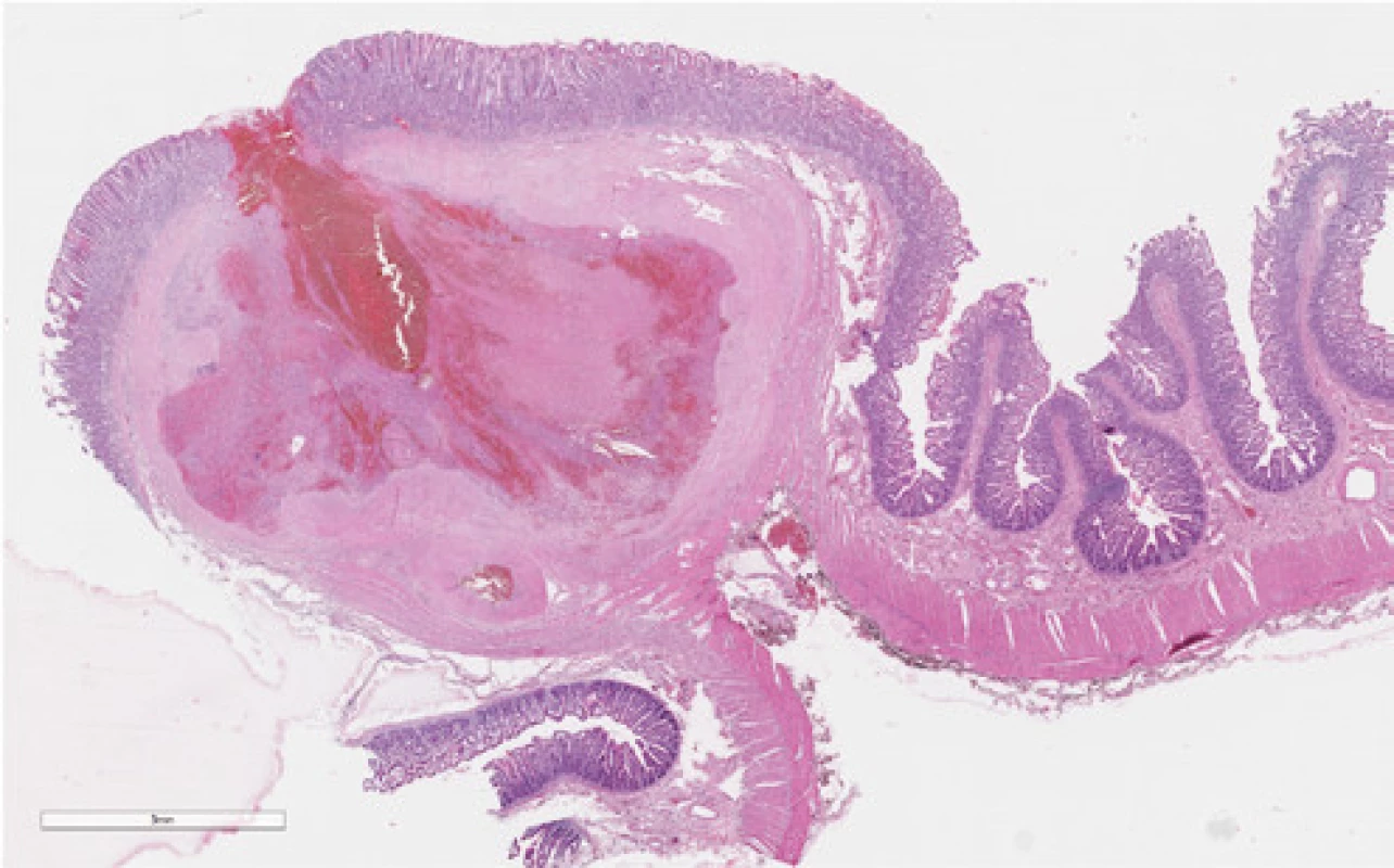 Dieulafoy lézia jejúna, hematoxylin‑eozin, 10× 