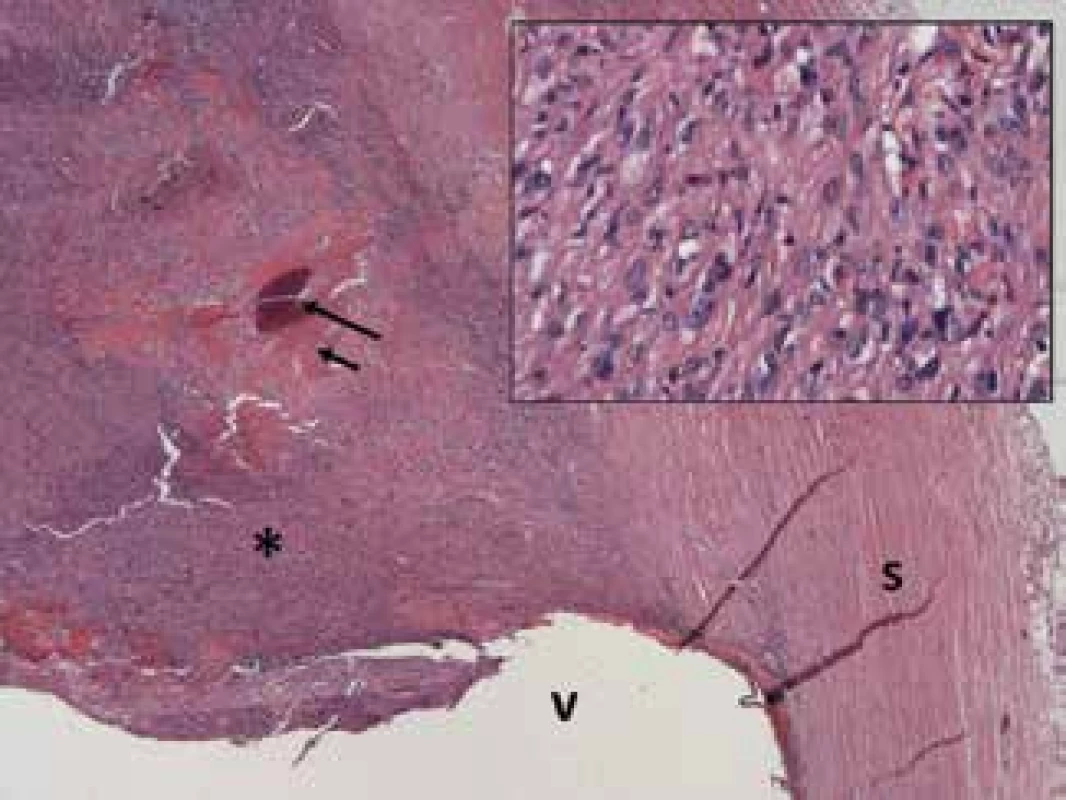 Neurofibroma growing inside eyeball (*) composed
of elongated cells with slightly vacuum cytoplasm and vesicular nuclei (insertion), focally with formation of osteoid
and ossification (short and long arrow); sclera (s), vitreous
(v). Haematoxylin and eosin – 25x, detail – 200x