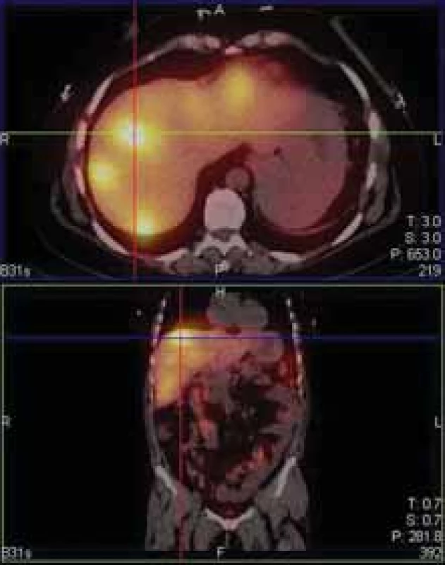 Mnohočetná ložiska záchytu 
111-In pentetreotidu v játrech.<br>
Fig. 5. Multiple 111-In pentetreotide 
positive lesions of the liver.