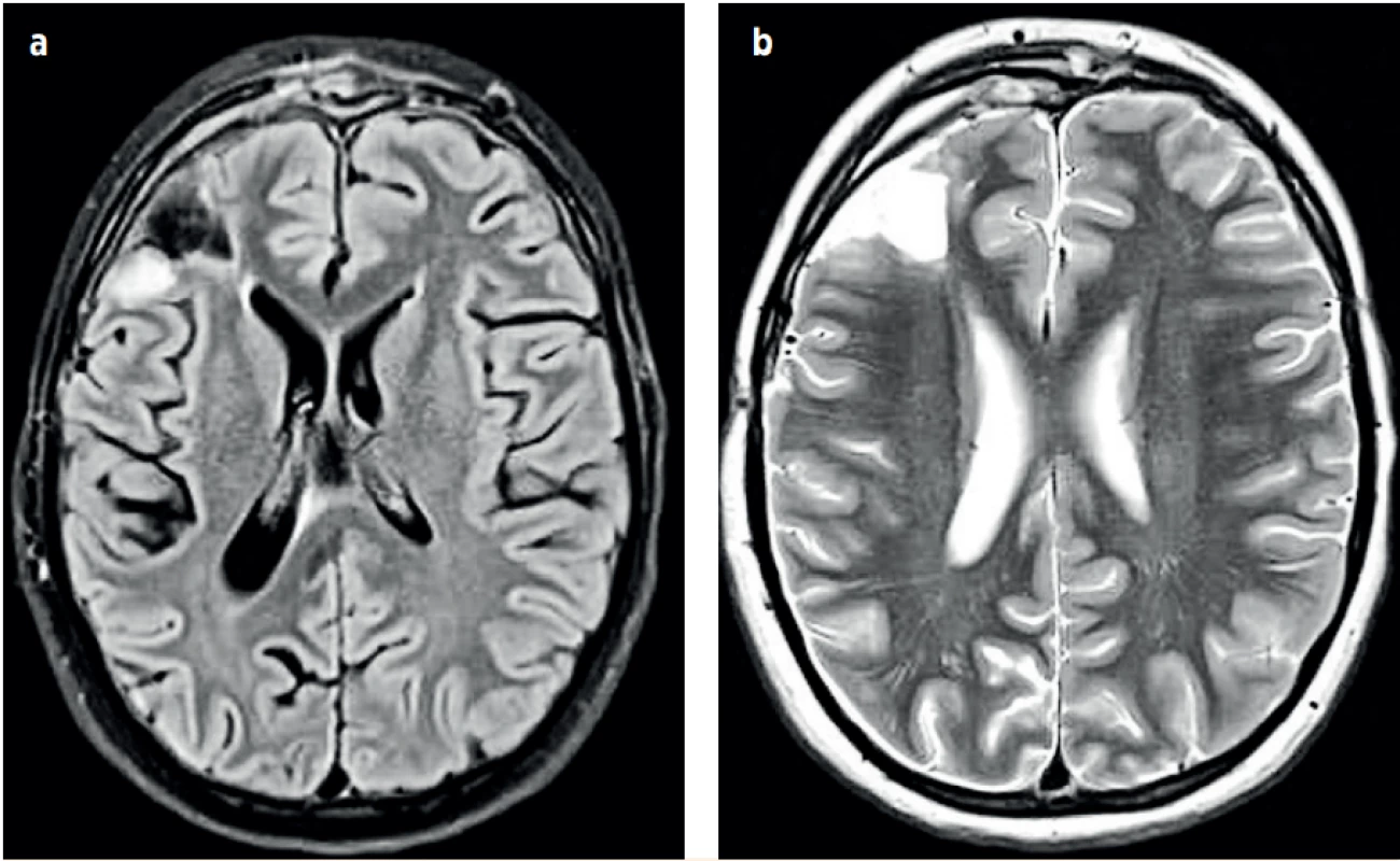 a, b (P1). Kontrolní NMR vyšetření hlavy v odstupu čtyřech měsíců – výsledný stav. (Za laskavého přispění MUDr. Pavla
Rejtara)<br>
Fig. 5a, b (P1). The brain MRI after four months – the resulting state. (Credit Dr. Pavel Rejtar)