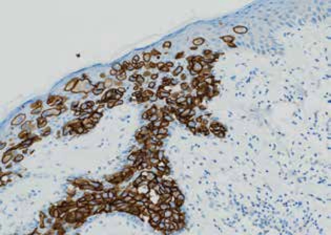 Epidermis prostoupená Pagetovými buňkami
HER2-pozitivními, zvětšeno 200× <br>
Fig. 1: Epidermis infiltrated by Paget cells, HER2-positive,
magnification 200×