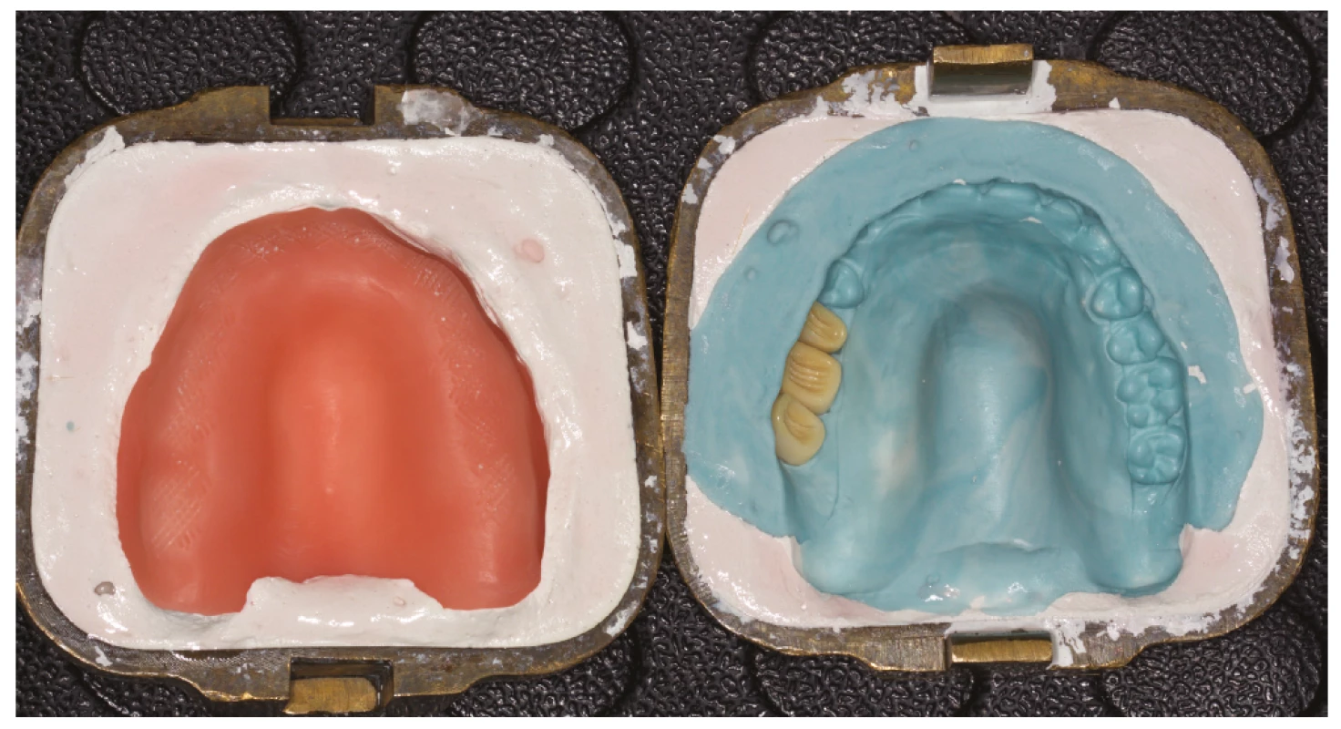 Příprava na polymerizaci
protézových zubů
k definitivní desce<br>
Fig. 3
Preparation for polymerization
of prosthetic teeth
to the final basis