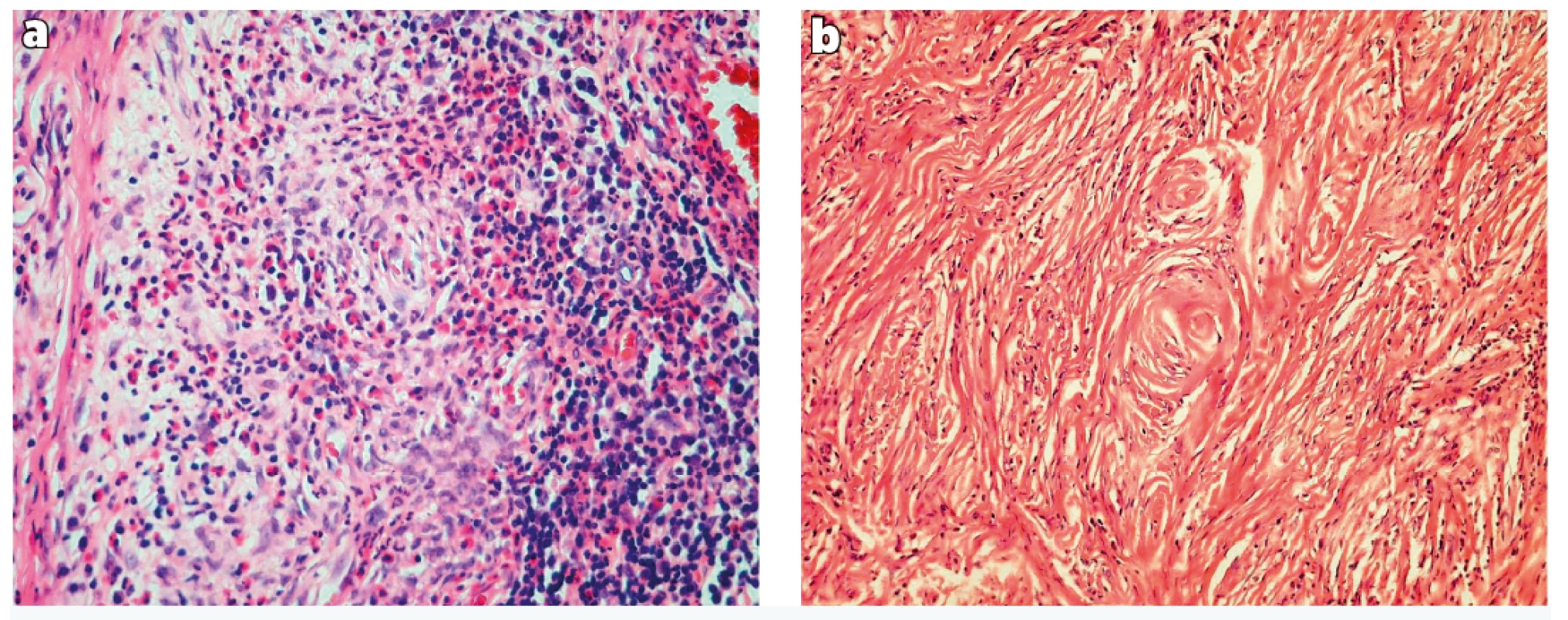 Histological findings.<br>
a) Dense fibrous connective tissue with chronic inflammatory cells and eosinophils surrounding small blood vessels (haematoxylin and
eosin, 200 x)<br>
b) Dense fibrotic stroma with concentric onion-skin perivascular fibrosis (haematoxylin and eosin, 100 x)
