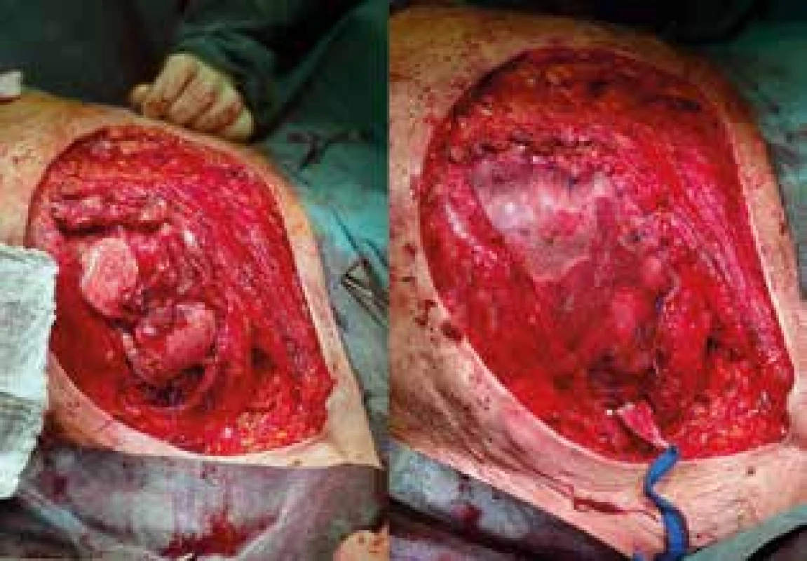 Stav po sanační mastektomii s resekcí hrudní stěny a po implantaci prolene mesh síťky<br>
Fig. 3: Perioperative image showing the patient after
mastectomy,chest wall resection andprolene mesh implantation