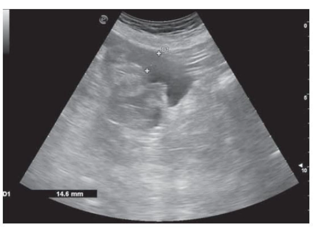 USG nález ascitu v cavum Douglasi.<br>
Fig. 2. USG finding of ascites in cavum Douglasi.