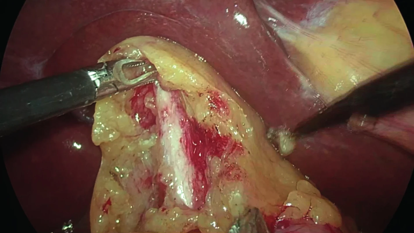 Dissected common hepatic duct (CHD) mistaken
for a shrunken gallbladder