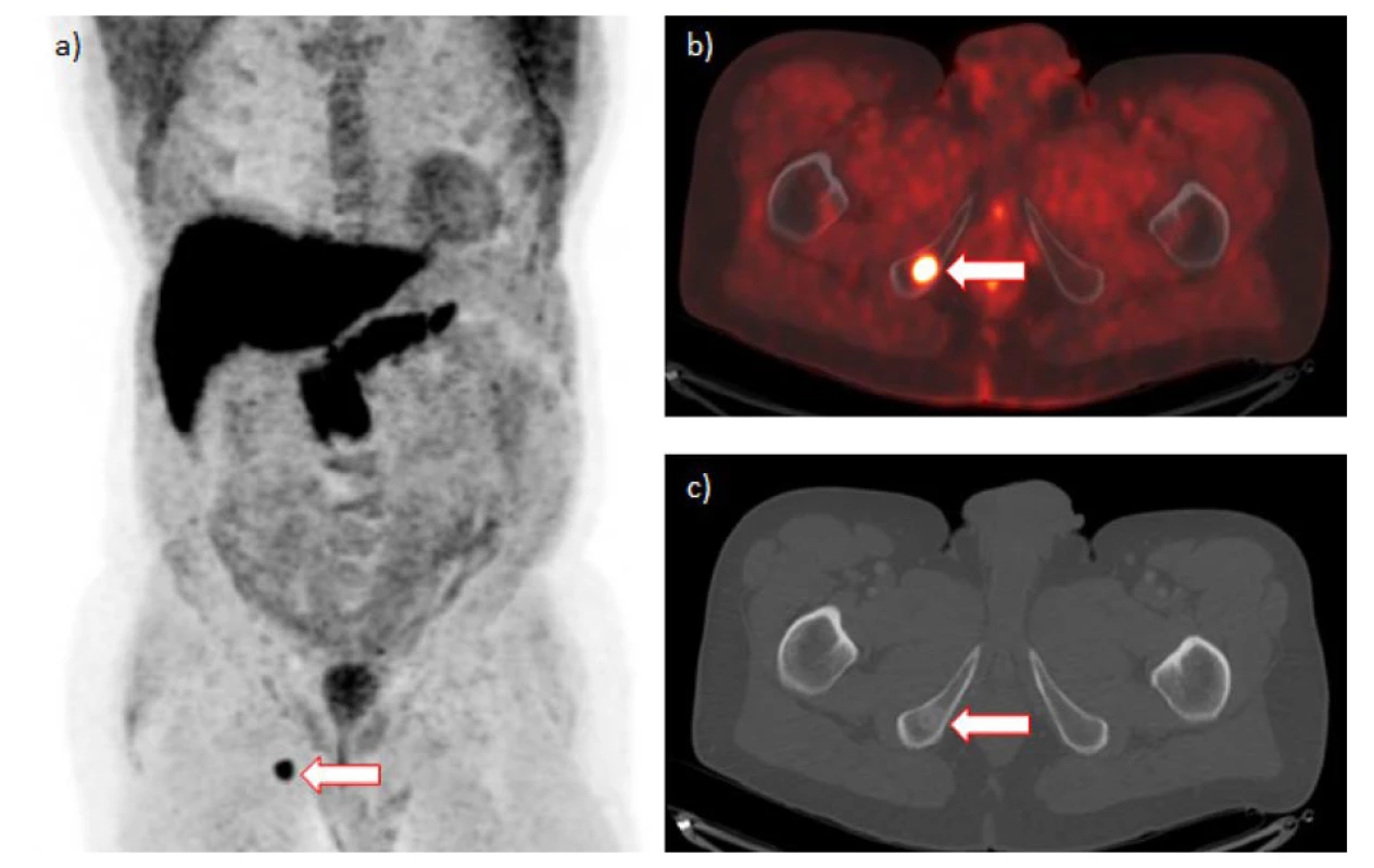 a–c. 18F-fluciklovin PET/CT s nálezem solitární metastázy v dolním raménku kosti stydké vpravo (šipka):
a) maximální projekce intenzity, b) fúze pozitronové emisní tomografie/počítačové tomografie, c) počítačová
tomografie (zobrazení skeletu)<br>
Fig. 1. a–c. 18F-fluciclovine PET/CT positive for solitary metastasis in the inferior ramus of the right pubic bone
(arrow): a) maximum intensity projection, b) positrone emission tomography/computed tomography fusion,
c) computed tomography (bone window)