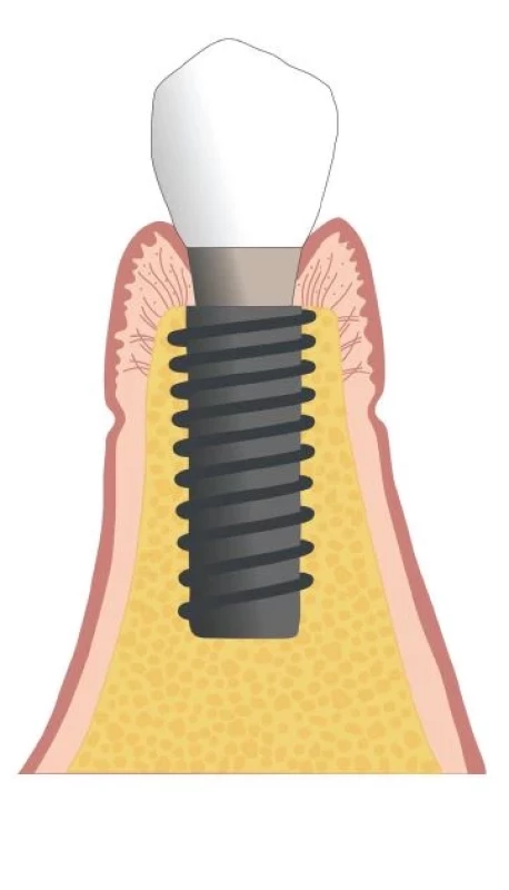 Zdravé peri-implantátové
tkanivá.<br>
Fig. 1
Peri-implant health.